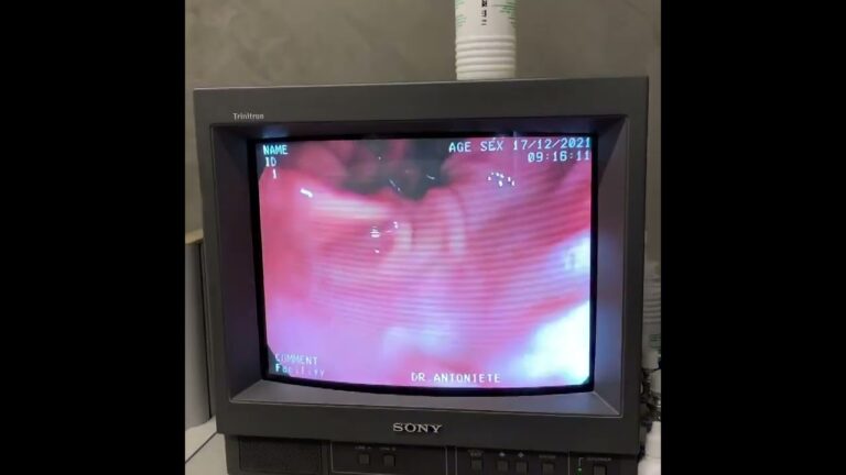 Cuidados com o Estômago Após Cirurgia Bariátrica