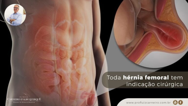 Tratamento eficaz para hernia femoral: opções e cuidados