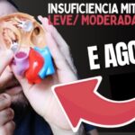 Cirurgia de Colelitíase: Procedimento otimizado e eficaz
