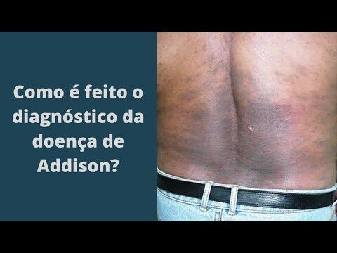 Fotos da Doença de Addison: Sintomas e Diagnóstico | Actualizado ...