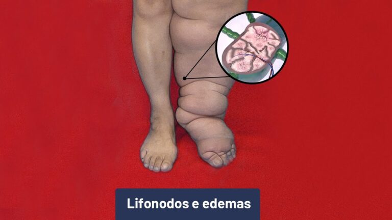 Edema Gravitacional: Causas e Tratamentos