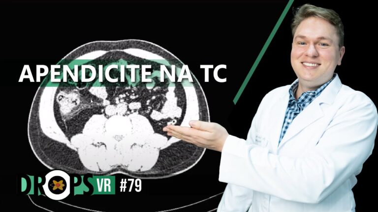 Diagnóstico de Apendicite por Tomografia Computadorizada: Uma Revisão