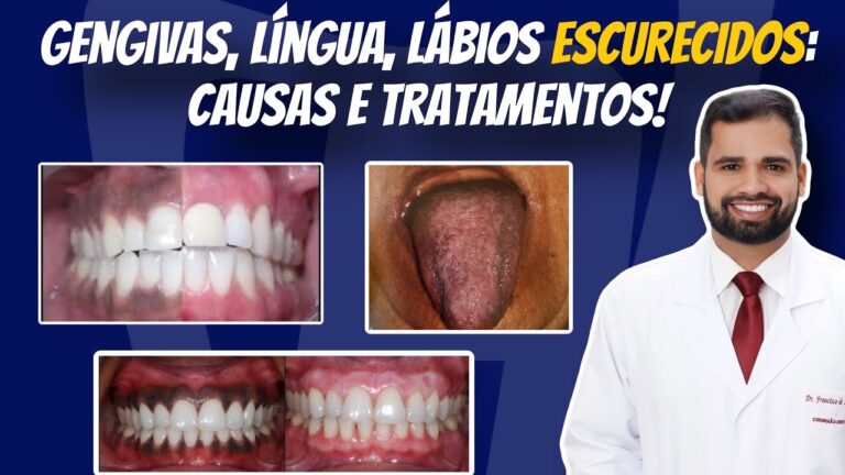 O que causa o escurecimento da gengiva? | Actualizado mayo 2026