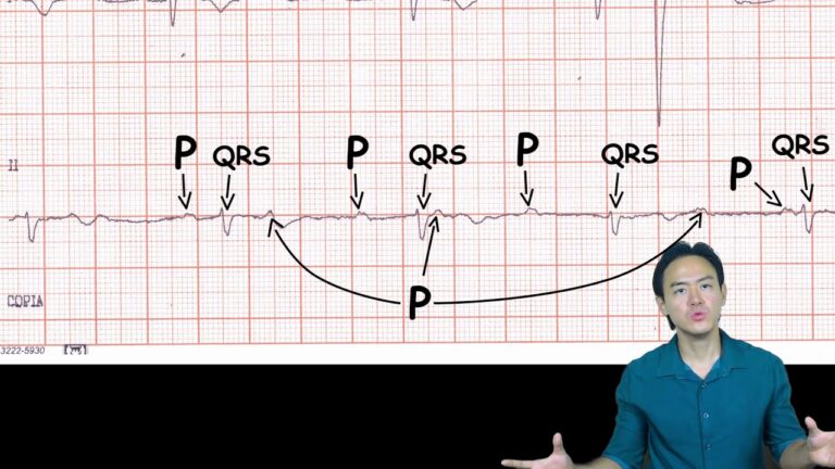 Benef&iacute;cios da Eletrocardiografia de Alta Velocidade