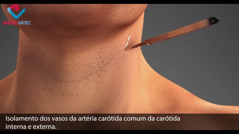 Avanços na Endarterectomia de Carótida: Benefícios e Indicações