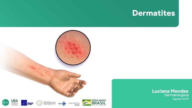 Guia Completo sobre Eczema Asteatósico