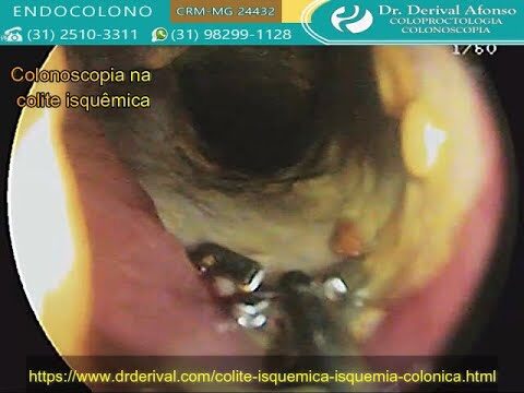 Colite Isquêmica: Causas, Sintomas e Tratamentos