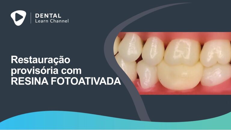 Restauração Provisória: Solução Rápida e Eficiente