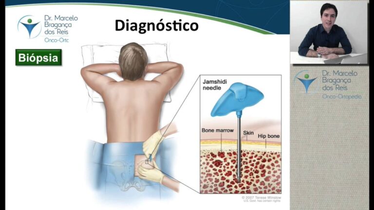 Mieloma M&uacute;ltiplo: Diagn&oacute;stico, Tratamento e Perspectivas