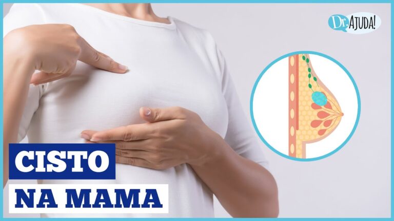 Entendendo o Cisto Mam&aacute;rio: Causas, Sintomas e Tratamento