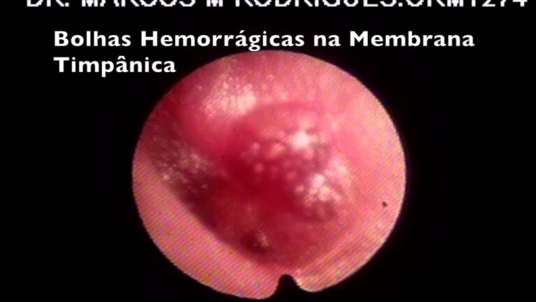 Tratamento eficaz para miringite bolhosa