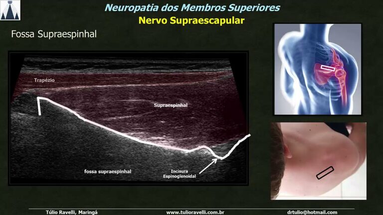 A importância da incisura espinoglenoidal: Aspectos clínicos e anatômicos
