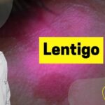 Cirurgia de Hernia Inguinal por Vídeo: Uma Abordagem Otimizada.