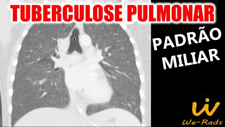 Tomografia na Tuberculose Miliar: Uma Análise Concisa