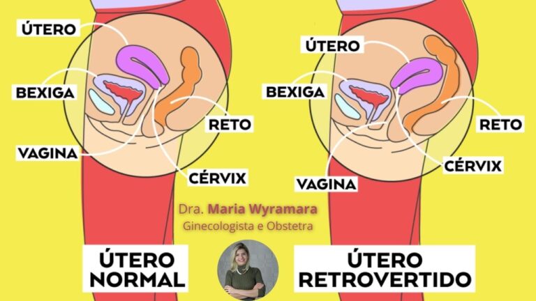 Entendendo o Colo do Útero Retrovertido: Causas e Implicações