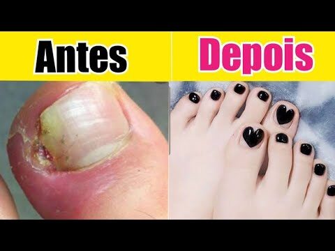 Tratamento eficaz da paroníquia com penicilina