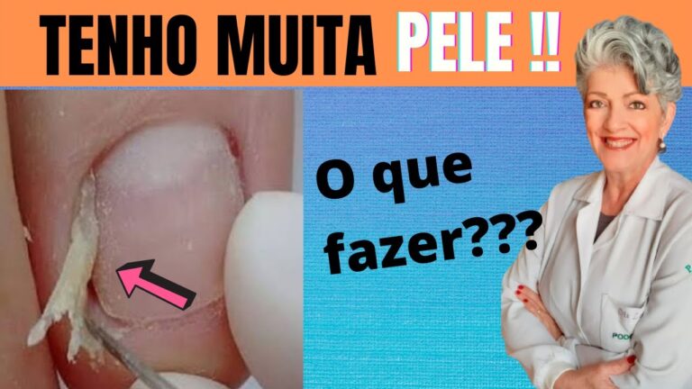 Remédio eficaz para onicofose
