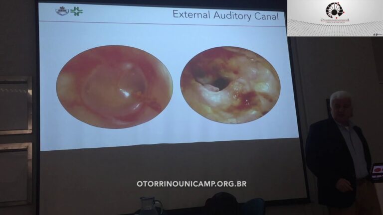 Colesteatoma: Entenda com Fotos Illustrativas