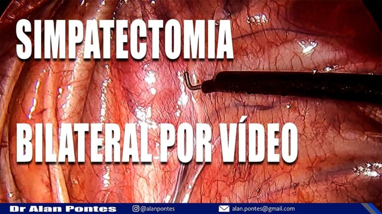 Simpatectomia Axilar: Indicações e Benefícios da Cirurgia