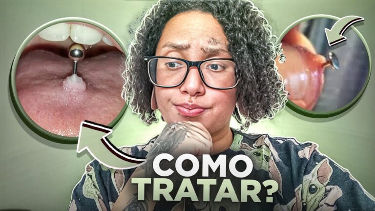 Granuloma na Língua: Causas e Tratamentos