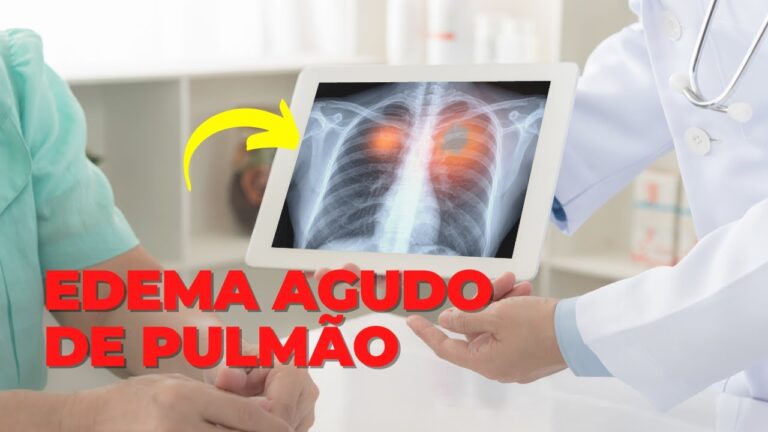 Sintomas do Edema Agudo de Pulmão: Guia Completo