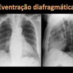 Cirurgia de Tendão na Mão: Tudo o Que Você Precisa Saber