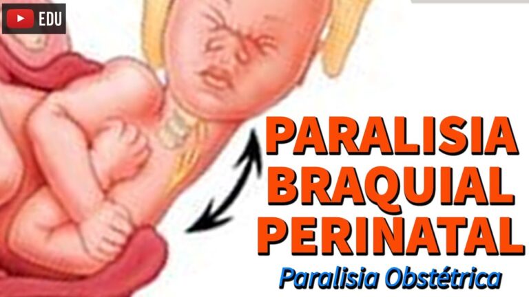 Entendendo a Paralisia Obstétrica Braquial: Causas e Tratamentos