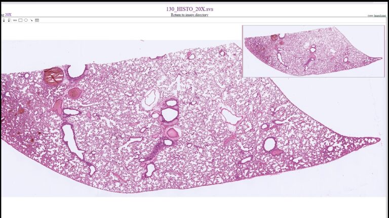 Antracose: causas, sintomas e tratamento