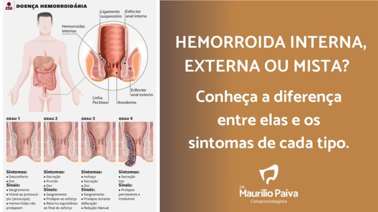 Tratamento eficaz para mamilos hemorroidários