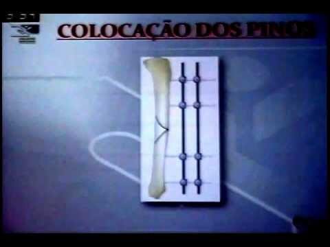 Guia para Escolher o Melhor Fixador de Colas