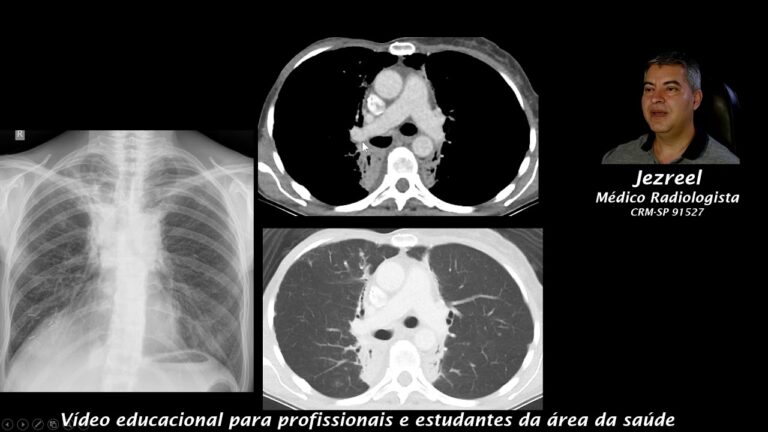 Pneumonite Actinica: Causas, Sintomas e Tratamentos