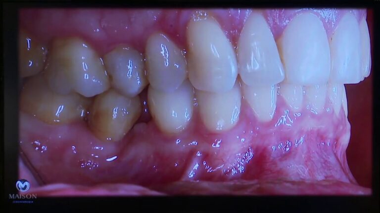 Imagens de cisto na raiz do dente: diagnóstico e tratamento
