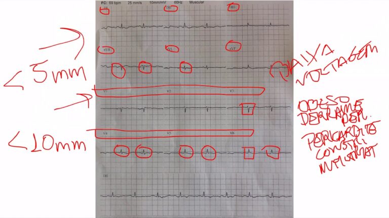 Baixa Voltagem no ECG: Significado e Implicações