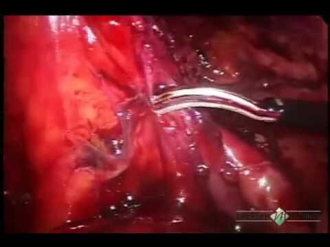 Tratamentos eficazes para fístula estercoral: uma revisão abrangente
