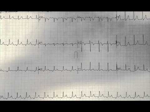 Sintomas do Ritmo Atrial Ectópico: Um Guia Completo