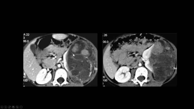 Fotos do Tumor de Wilms: Conheça os Sintomas e Tratamentos