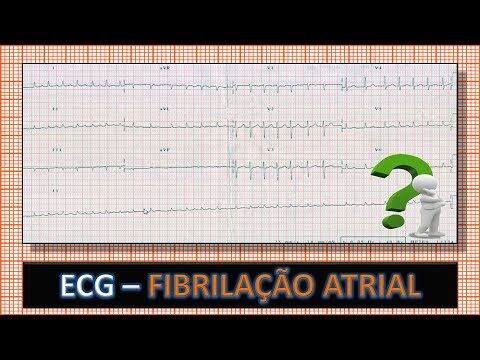 Tratamento da fibrilação atrial com alta resposta ventricular