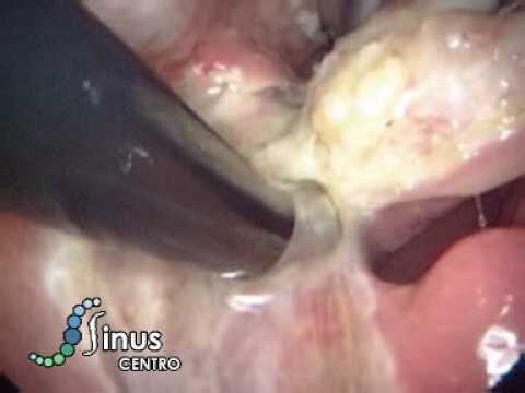 Amigdalectomia: Antes e Depois