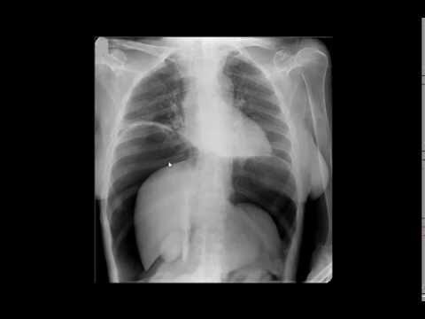 Pneumoperitônio: Gravidade da Condição