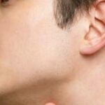 Prepúcio: Hipertrofia e Tratamento