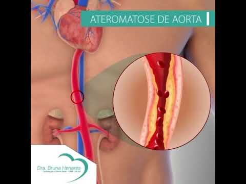 Ateromatose Aortoilíacas: Causas, Sintomas e Tratamento