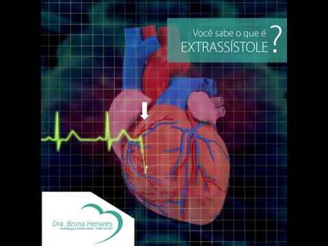 S&iacute;ndrome da Extra S&iacute;stole Atrial: Causas e Tratamentos