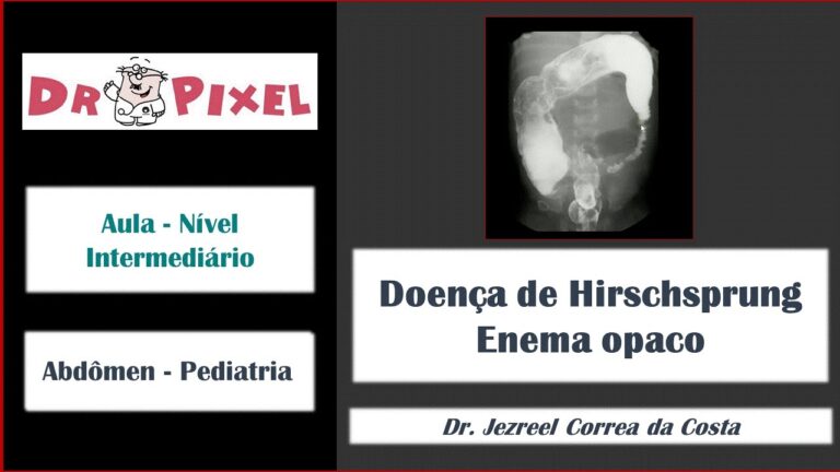 Entendendo a Doença de Hirschsprung: Causas e Tratamentos