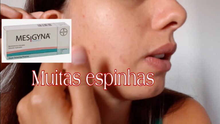 Mesigyna: Mitos e Verdades sobre Acne