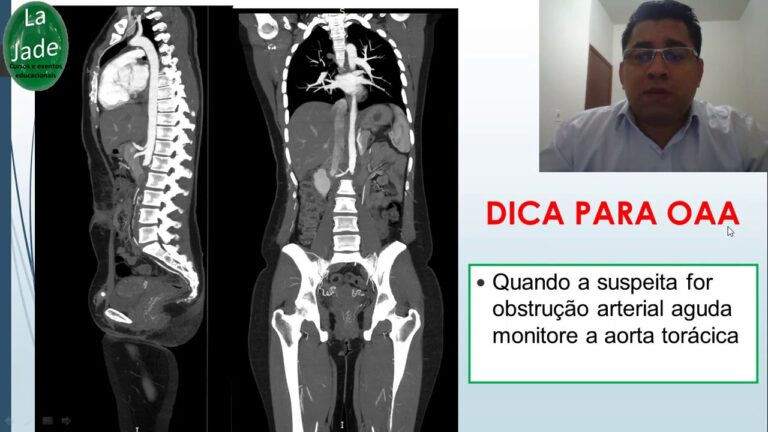 Angiotomografia da Aorta Abdominal e Ilíacas: O que você precisa saber