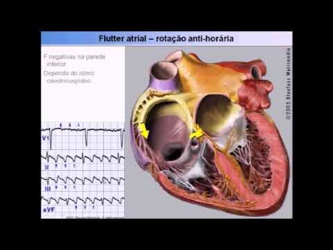 Medicamento eficaz para taquicardia supraventricular