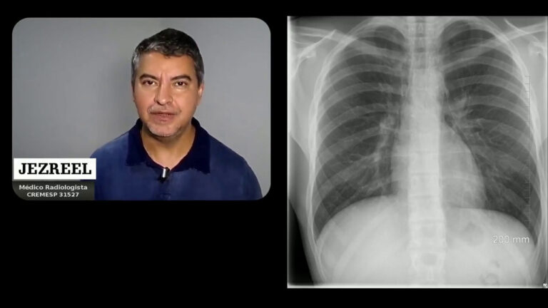 Pneumomediastino: Causas, Sintomas e Tratamentos