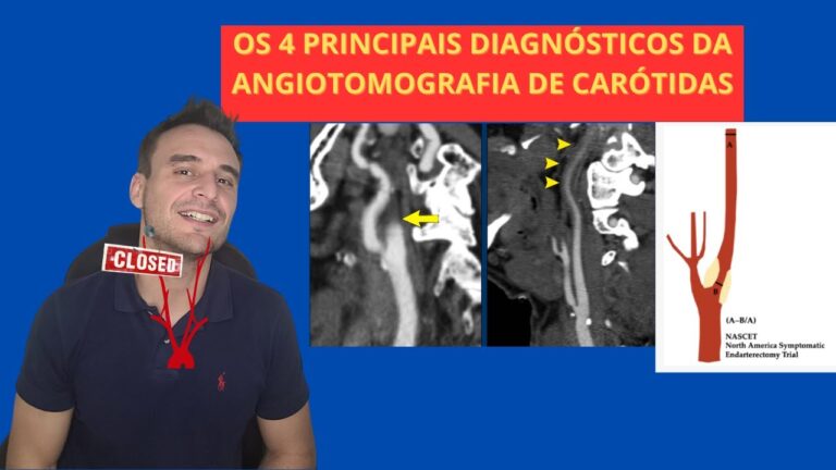 Angiotomografia de Carótidas: O Que Você Precisa Saber