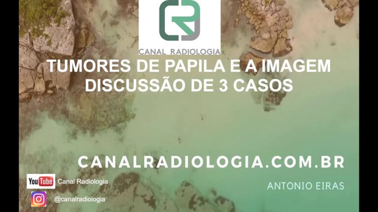 Sintomas do Tumor de Papila Duodenal: O que Você Precisa Saber