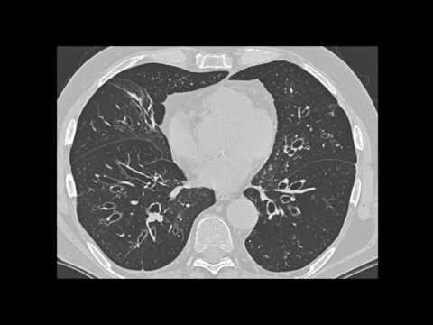 Bronquiectasia: Diagnóstico por Raio X